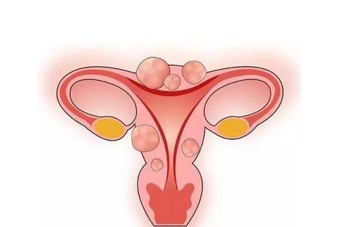 昆明女性子宫肌瘤分四个类型 有压迫症状要及时检查